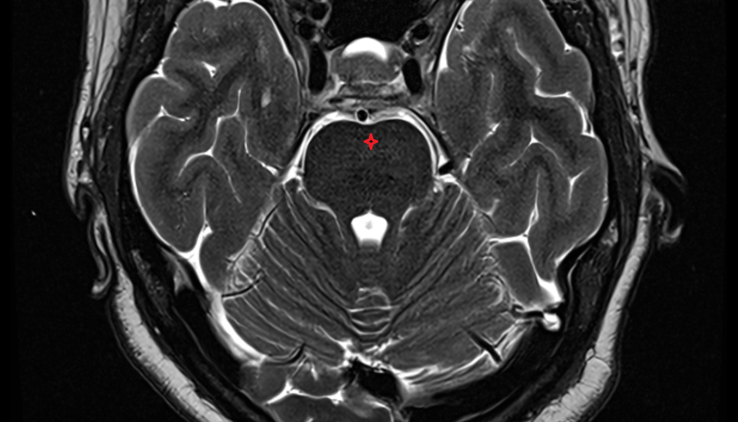 MRI  Basilar part of pons axial anatomy image -img-00000-00000