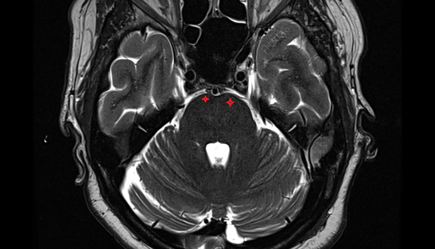 MRI Basilar portion of the pons axial anatomy image -img-00000-00000