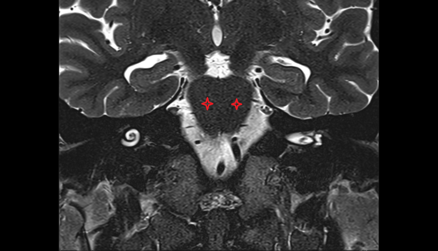 MRI Basilar portion of the pons coronal anatomy image -img-00000-00000