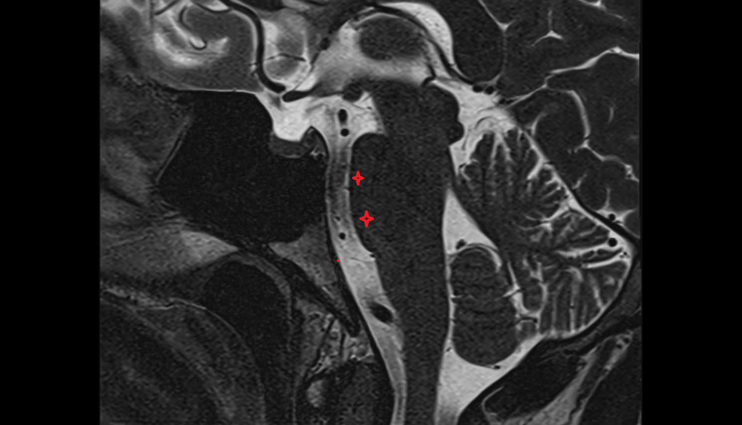 MRI Basilar portion of the pons sag anatomy image -img-00000-00000
