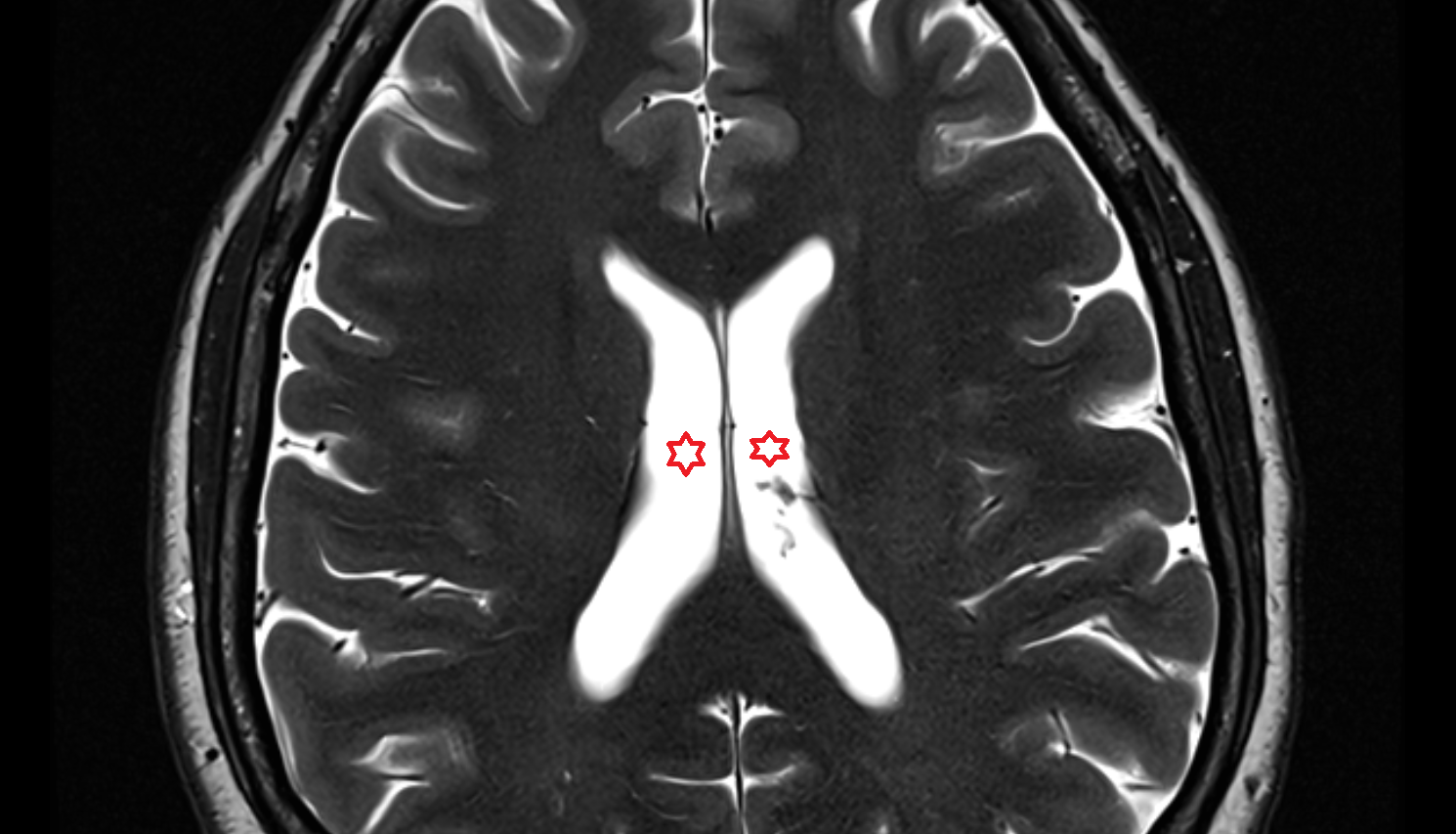 MRI Body of lateral ventricle AXIAL  anatomy image -img-00000-00000