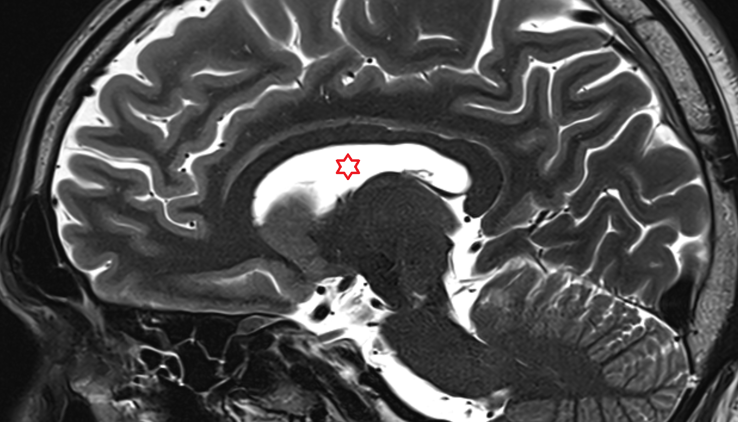 MRI Body of lateral ventricle sag  anatomy image -img-00000-00000