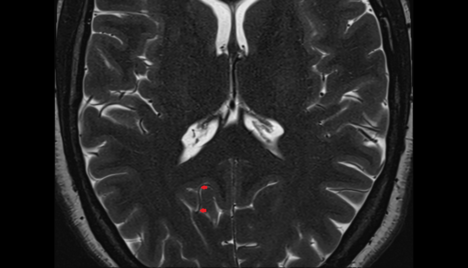 MRICalcarine branch of posterior cerebral artery anatomy image -img-00000-00000