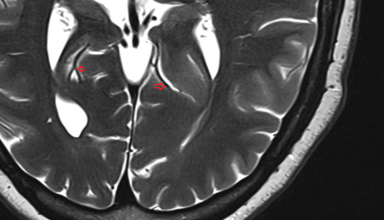MRICalcarine branch of posterior cerebral artery anatomy image -img-00000-00000_00001