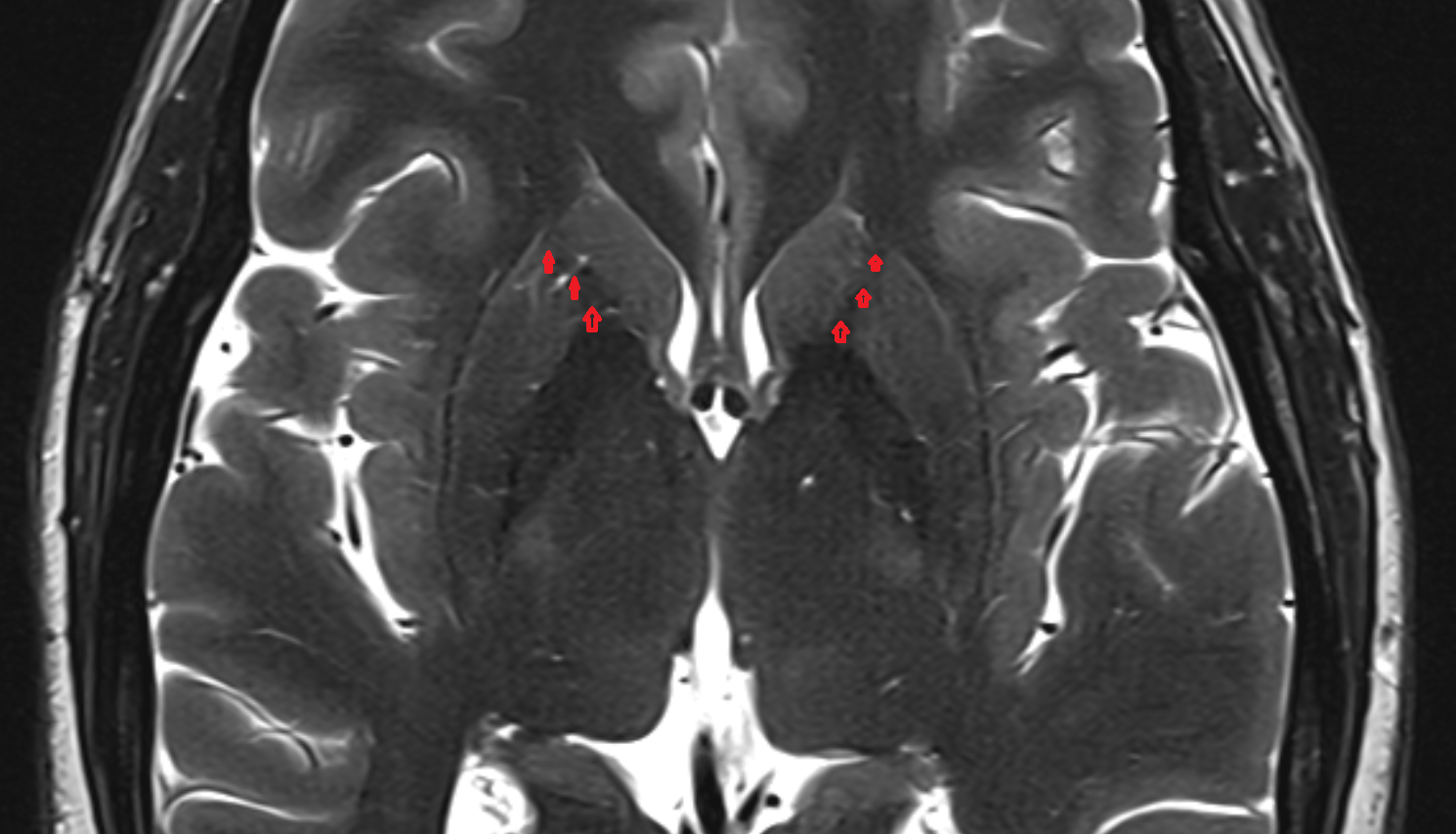 MRI Caudatolenticular gray bridges  anatomy image -img-00000-00000