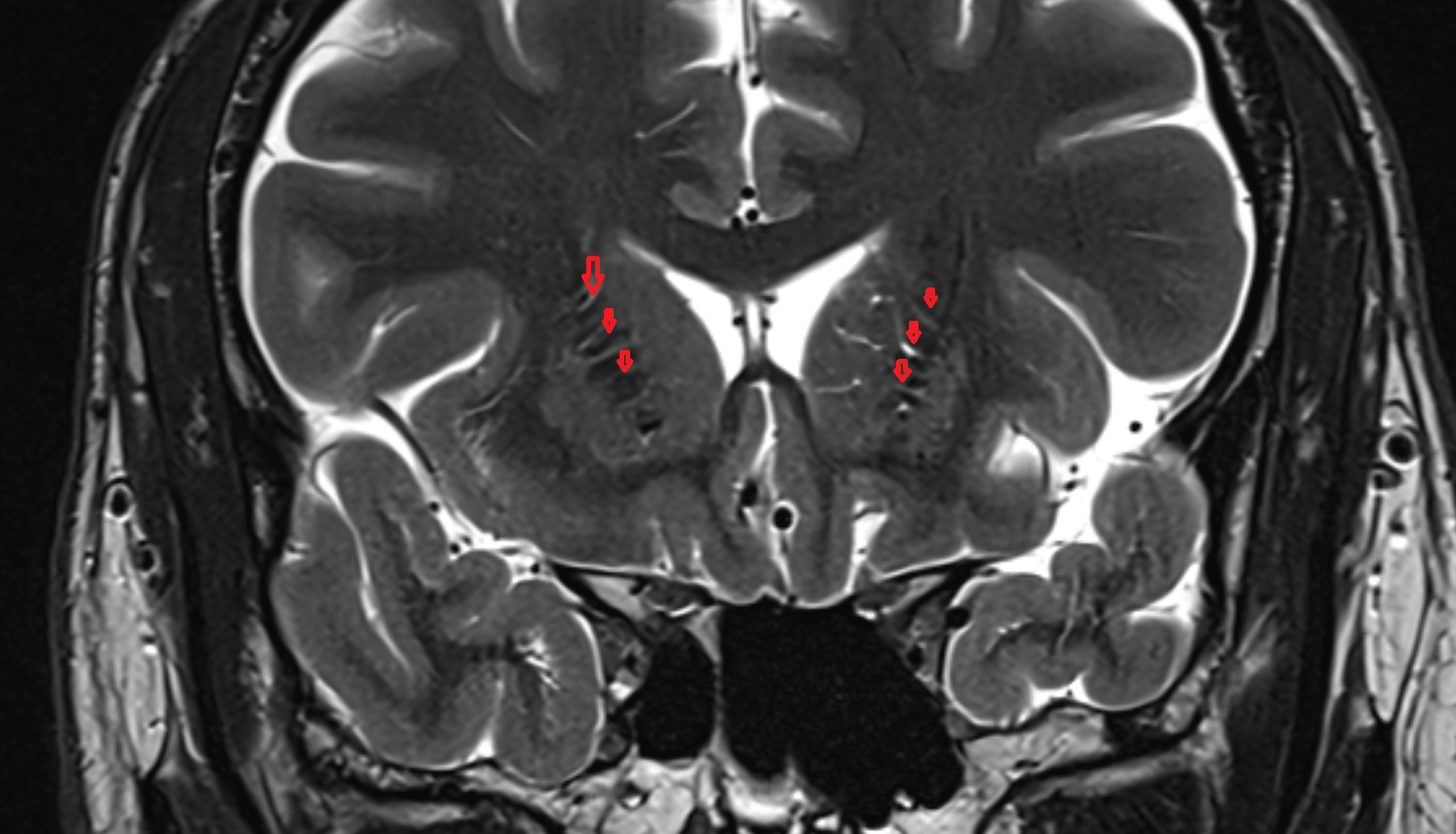MRI Caudatolenticular gray bridges coronal anatomy image -img-00000-00000