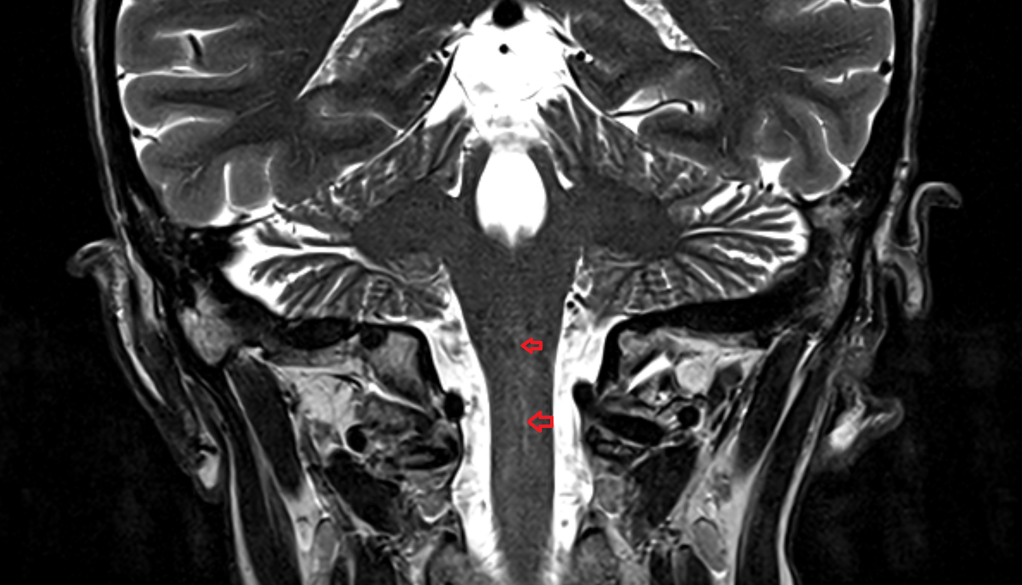 MRI Central canal coronal anatomy image