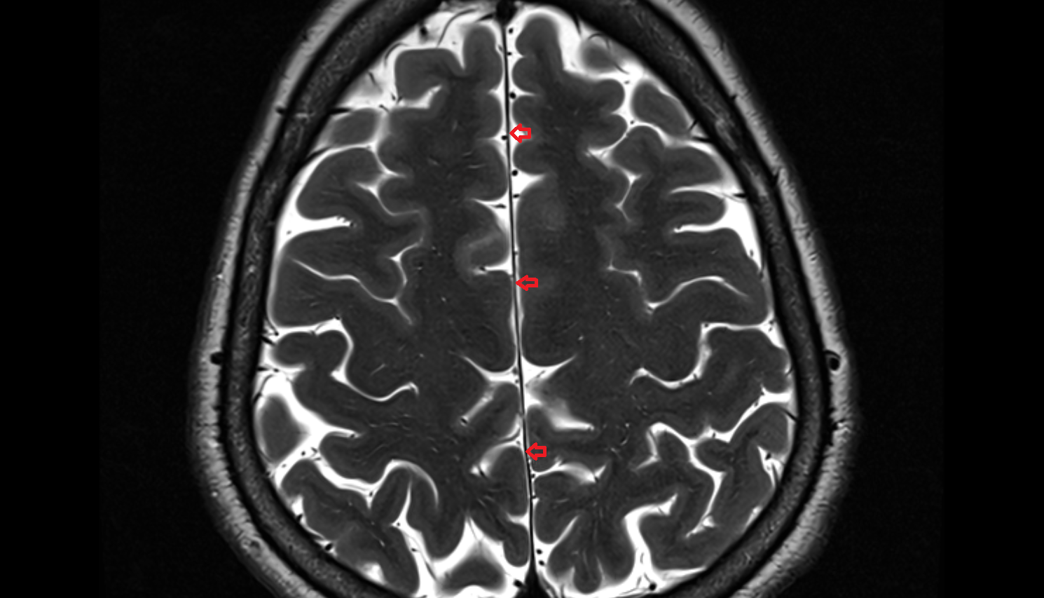MRI Cerebral falx axial anatomy image -img-00000-00000_00001