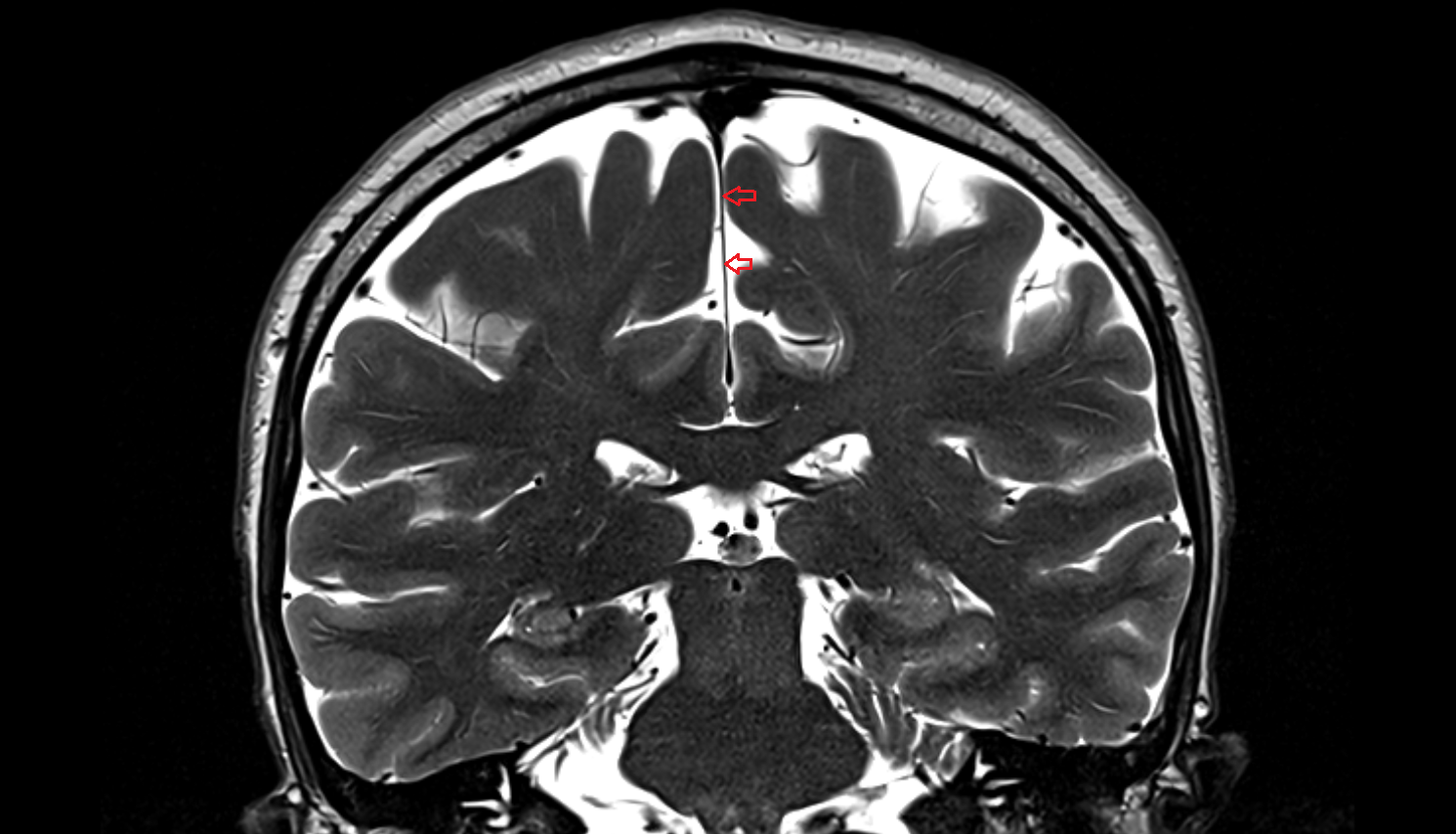 MRI Cerebral falx coronal anatomy image -img-00000-00000