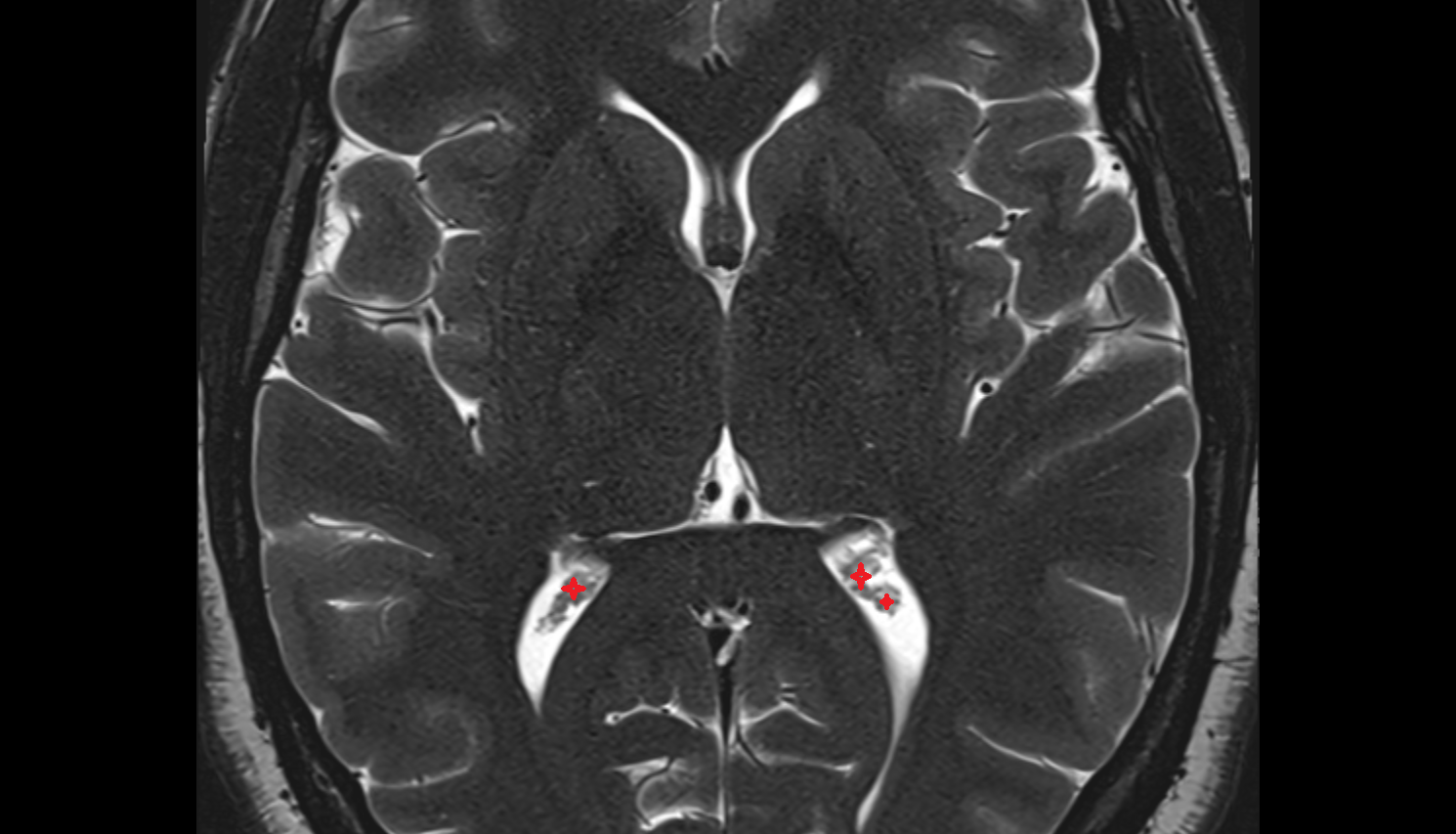 MRI Choroid plexus of the lateral ventricle anatomy image -img-00000-00000
