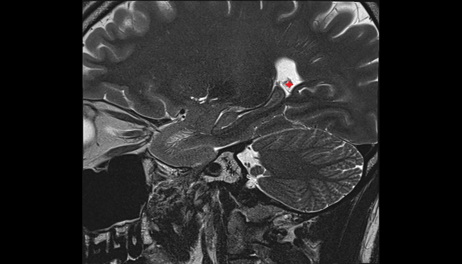 MRI Choroid plexus of the lateral ventricle anatomy image -img-00000-00000_00001