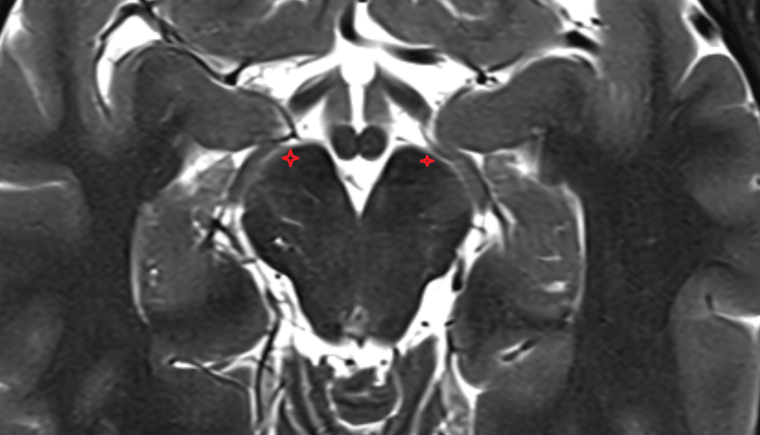 MRI Crus cerebri axial anatomy image -img-00000-00000_00001