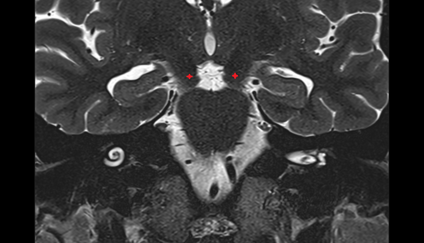 MRI Crus cerebri coronal anatomy image -img-00000-00000