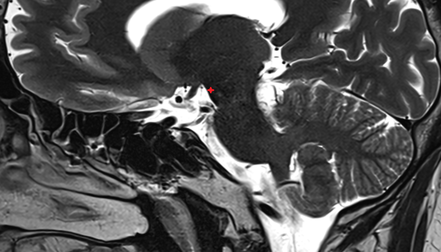 MRI Crus cerebri sag anatomy image -img-00000-00000