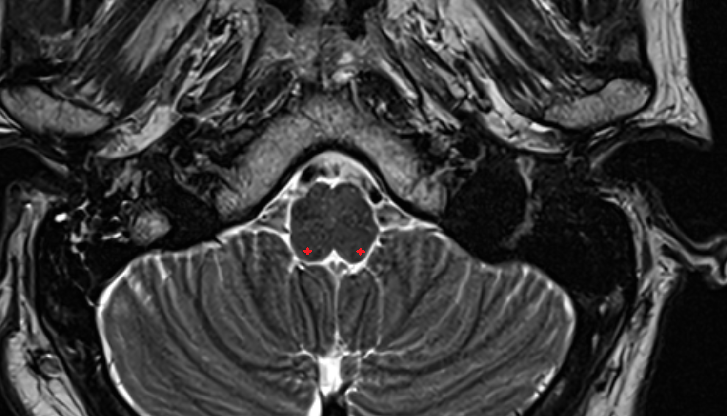 MRI Cuneate fasciculus axial anatomy image -img-00000-00000
