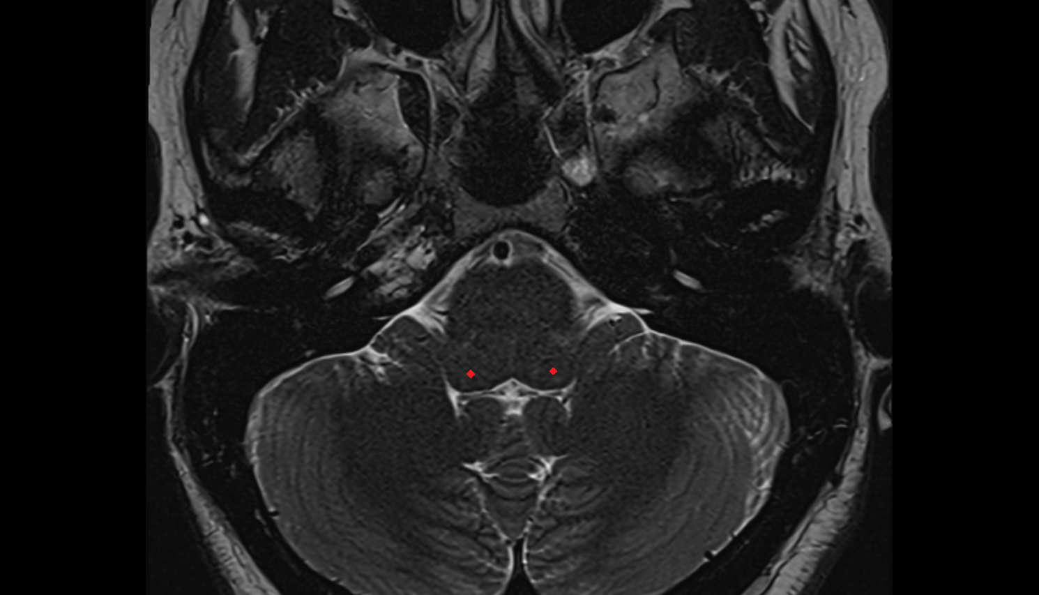 MRI Dorsal cochlear nucleus  axial anatomy image -img-00000-00000_00001