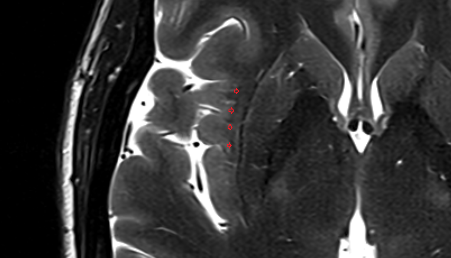 MRI Extreme capsule axial anatomy image -img-00000-00000