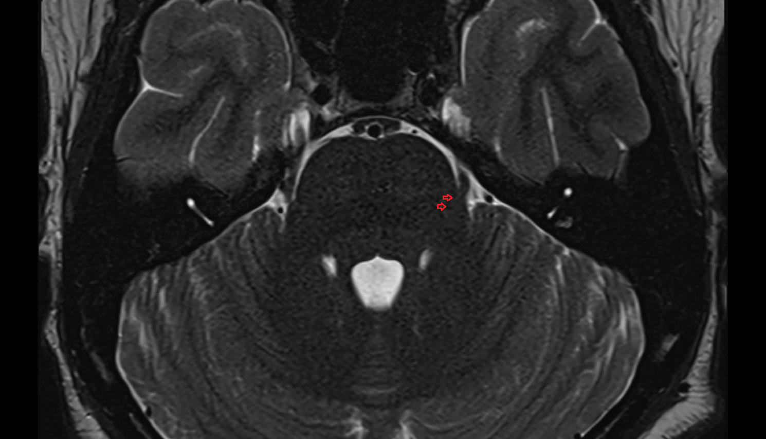 MRI Fibers of trigeminal nerve axial anatomy image -img-00000-00000