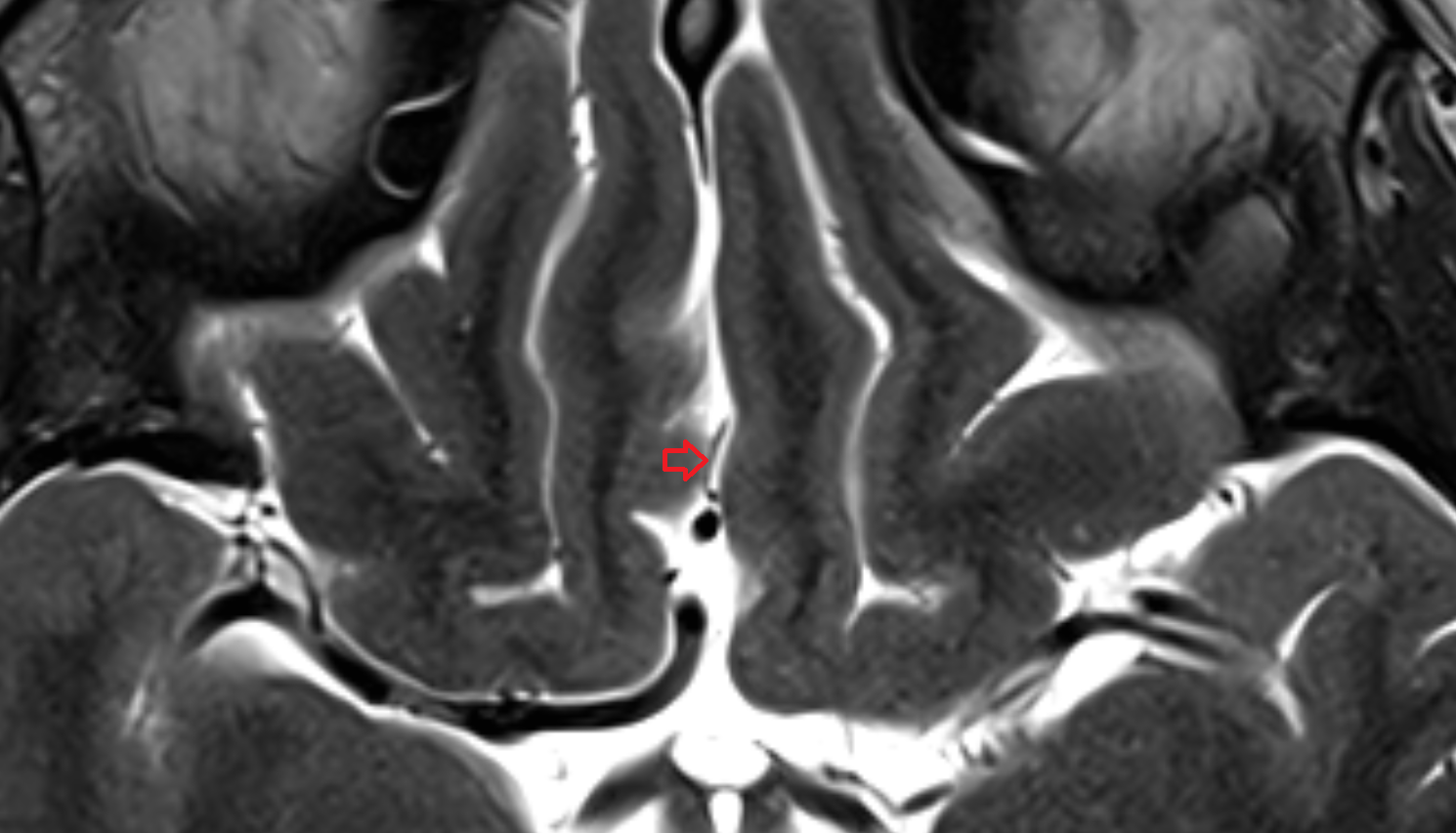 MRI Fronto_basal (orbitofrontal) artery axial  anatomy image -img-00000-00000