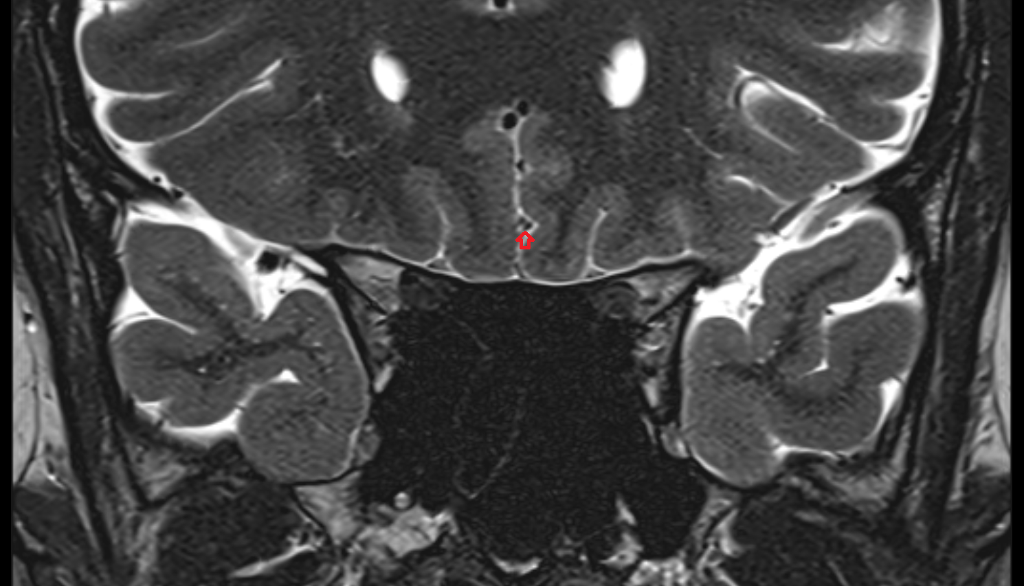 MRI Fronto_basal (orbitofrontal) artery coronal anatomy image -img-00000-00000