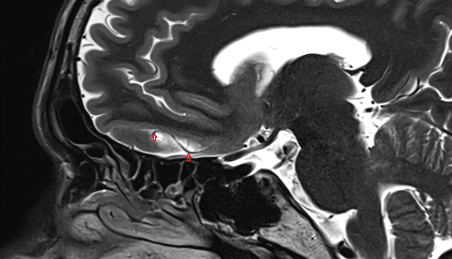 MRI Fronto_basal (orbitofrontal) artery sagittal anatomy image -img-00000-00000
