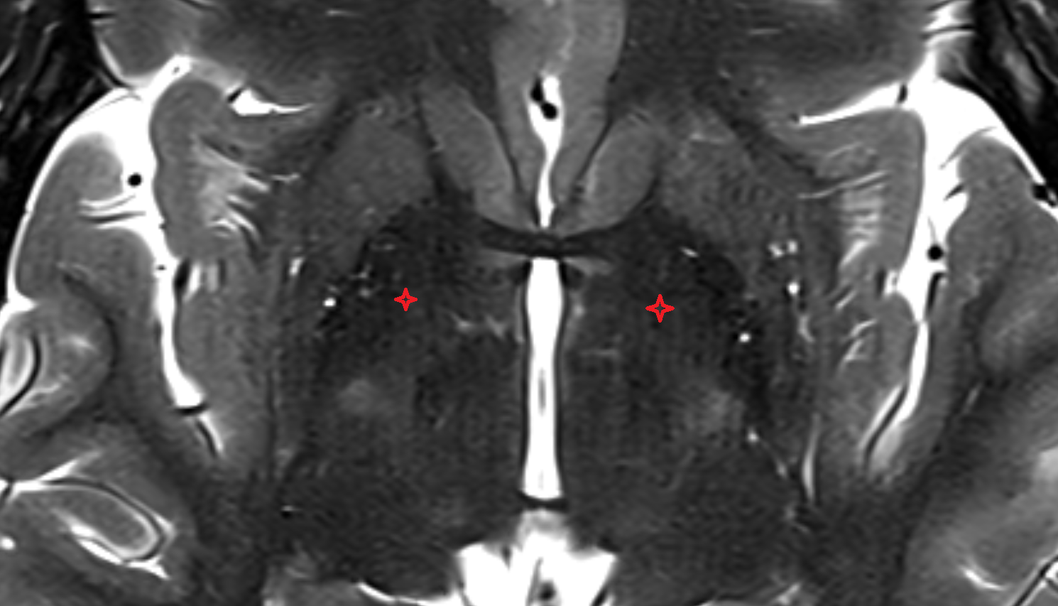 MRI Globus pallidus internal (medial) segment axial anatomy image -img-00000-00000