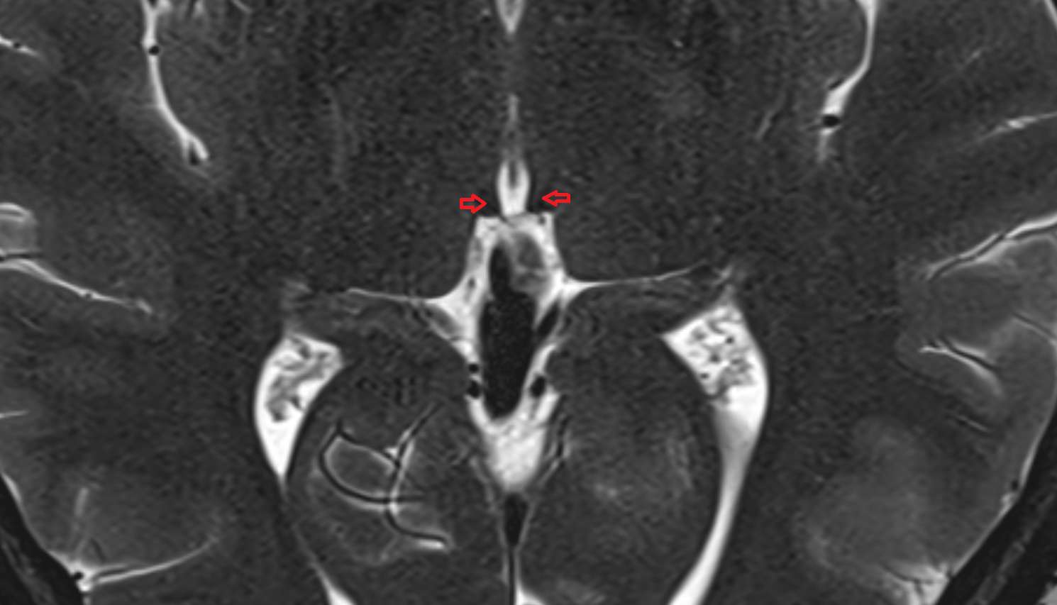 MRI Habenula anatomy image -img-00000-00000