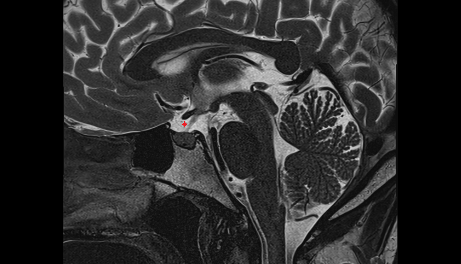 MRI Hypophysial cistern axial anatomy image -img-00000-00000