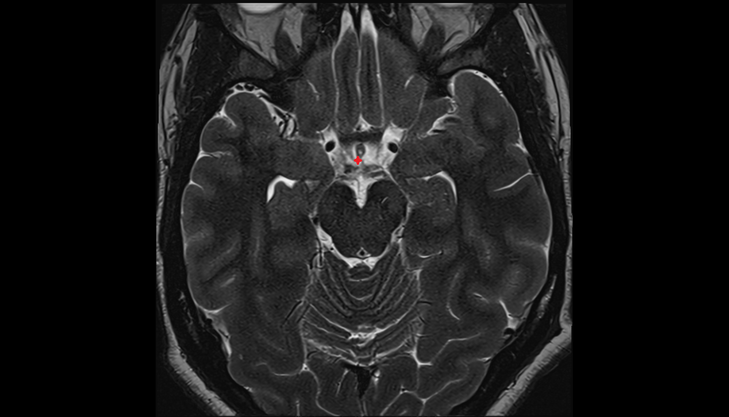 MRI Hypophysial cistern axial anatomy image -img-00000-00000_00001