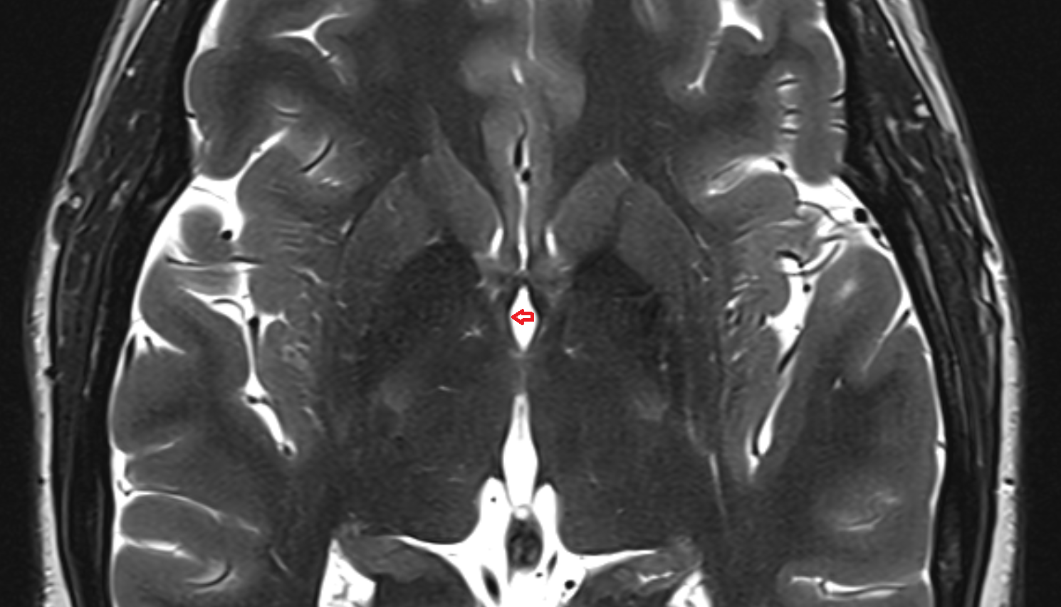 MRI Hypothalamic sulcus  anatomy image -img-00000-00000