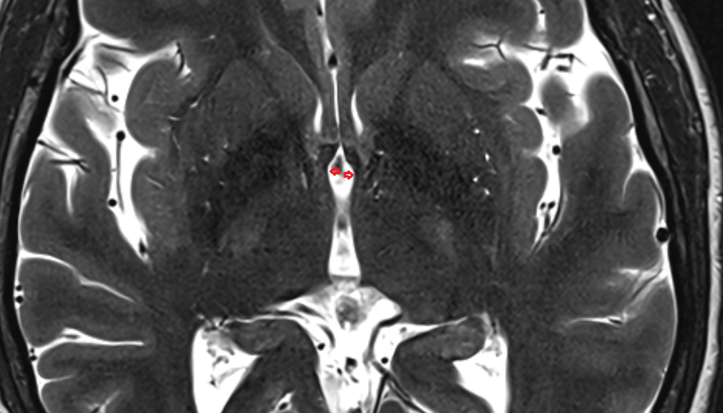 MRI Hypothalamic sulcus  anatomy image -img-00000-00000_00001