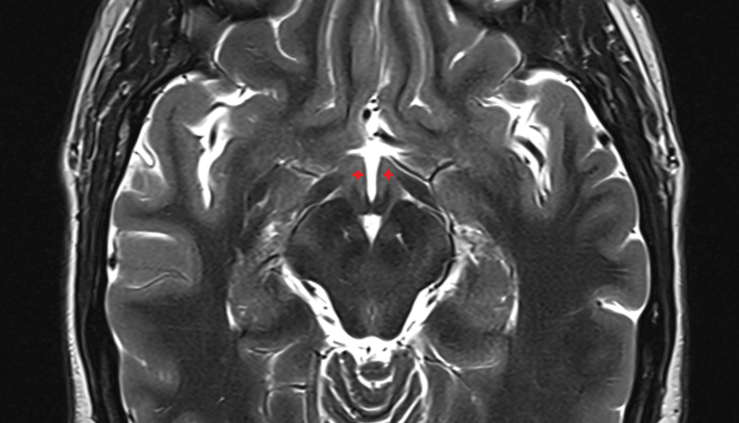 MRI Hypothalamus axial anatomy image -img-00000-00000