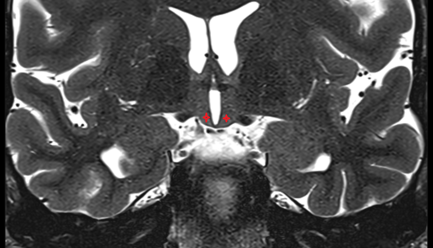 MRI Hypothalamus  coronal anatomy image -img-00000-00000