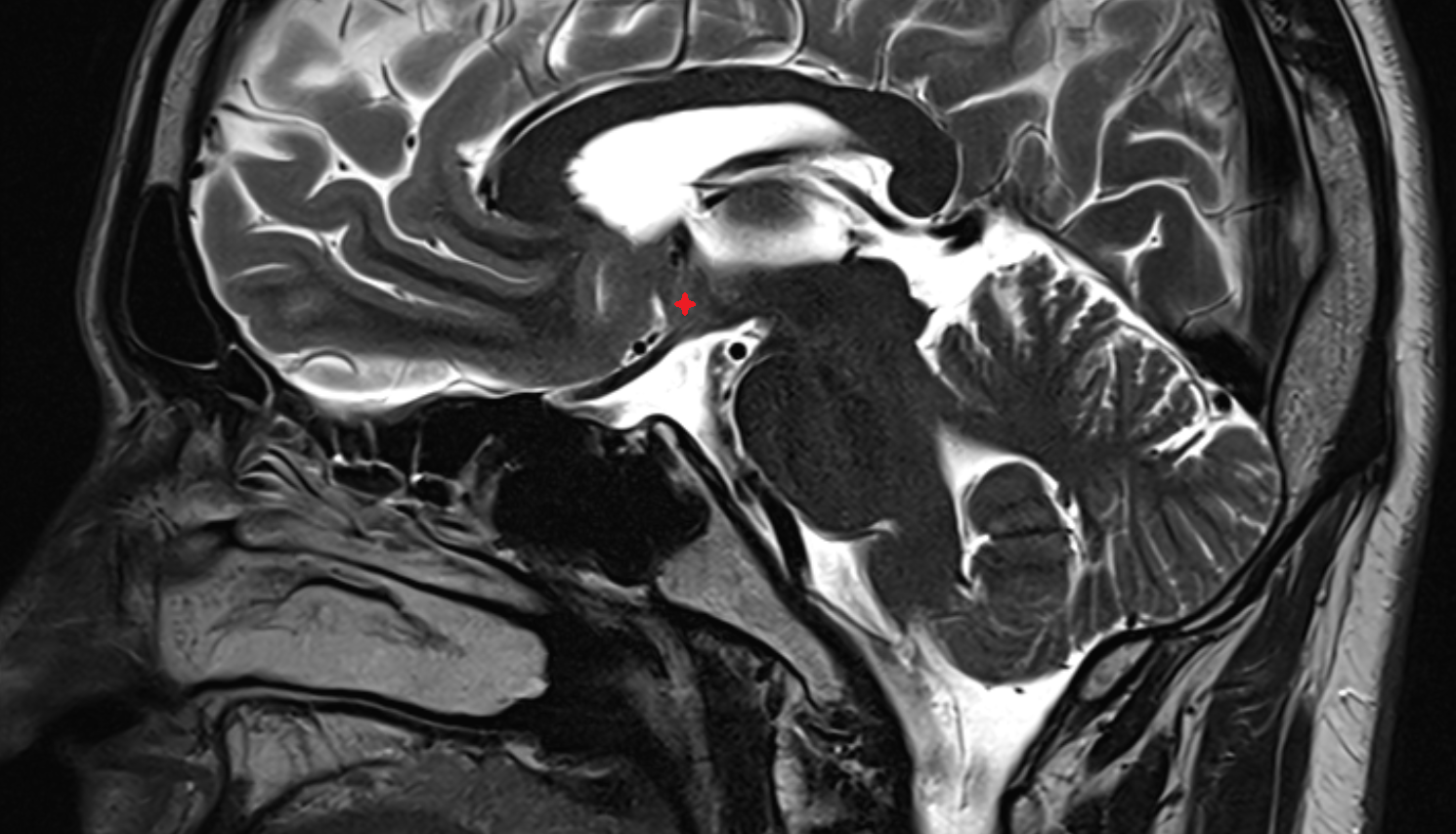 MRI Hypothalamus  sag anatomy image -img-00000-00000