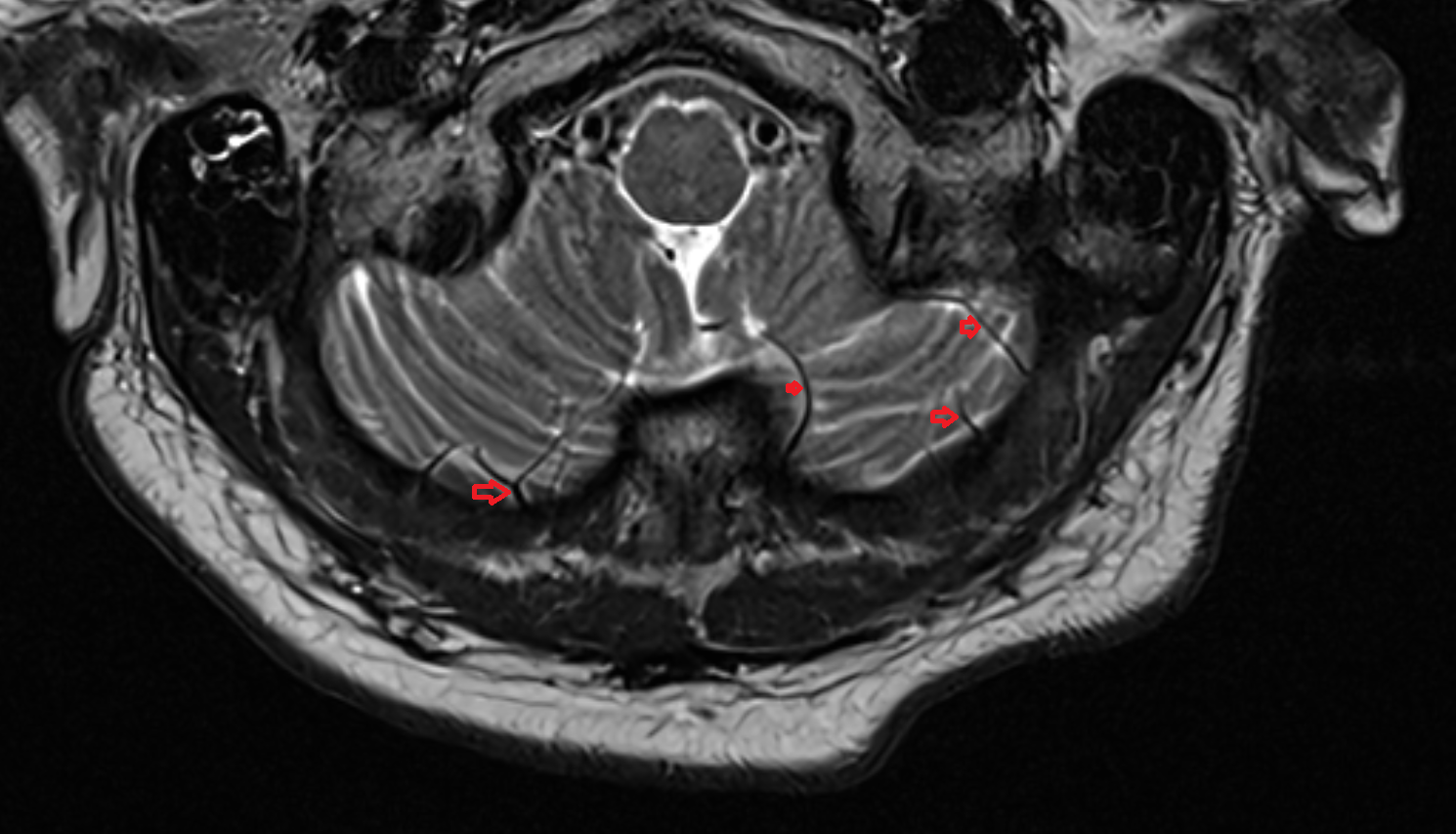 MRI Inferior hemispheric cerebellar veins axial anatomy image -img-00000-00000
