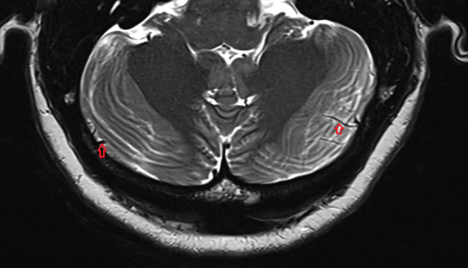 MRI Inferior hemispheric cerebellar veins axial anatomy image -img-00000-00000_00001