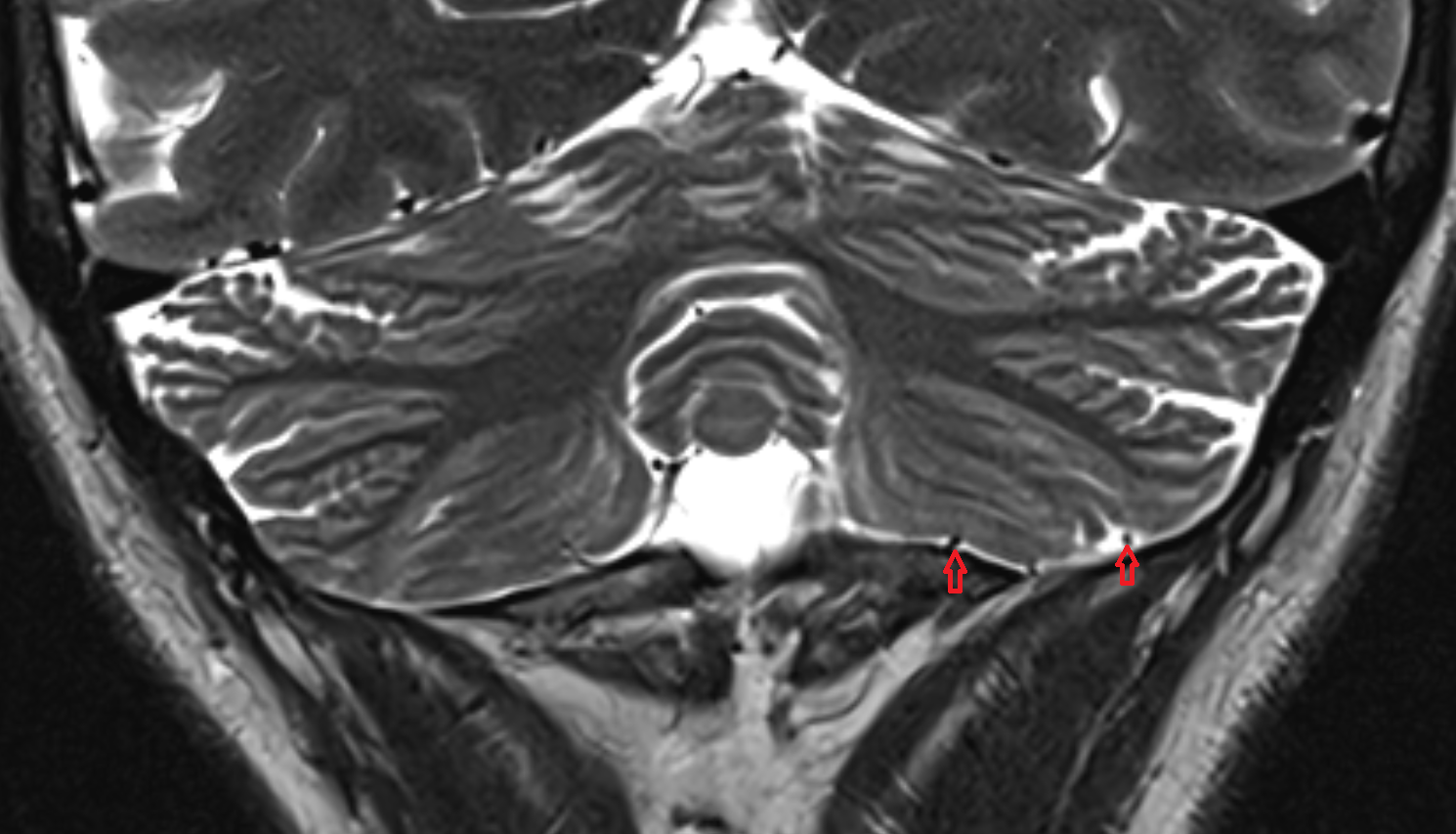 MRI Inferior hemispheric cerebellar veins coronal anatomy image -img-00000-00000