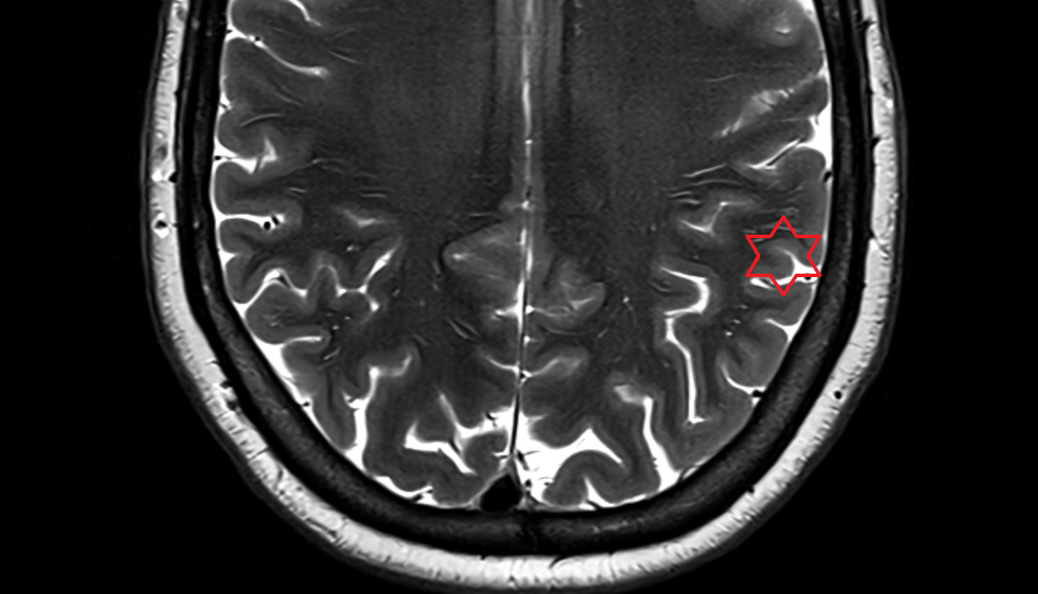 MRI Inferior parietal lobule  axial  anatomy image -img-00000-00000