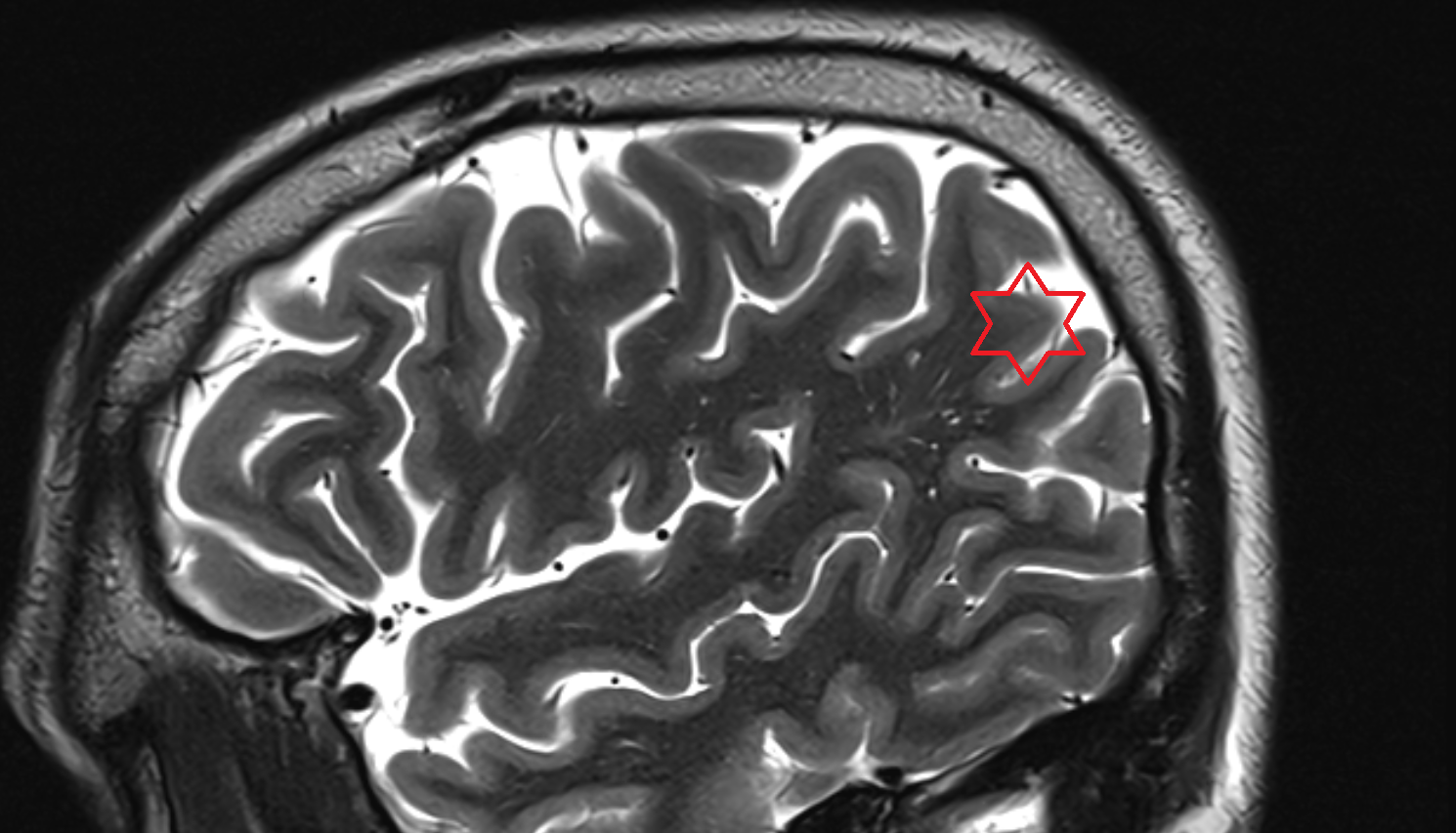 MRI Inferior parietal lobule sag  anatomy image -img-00000-00000