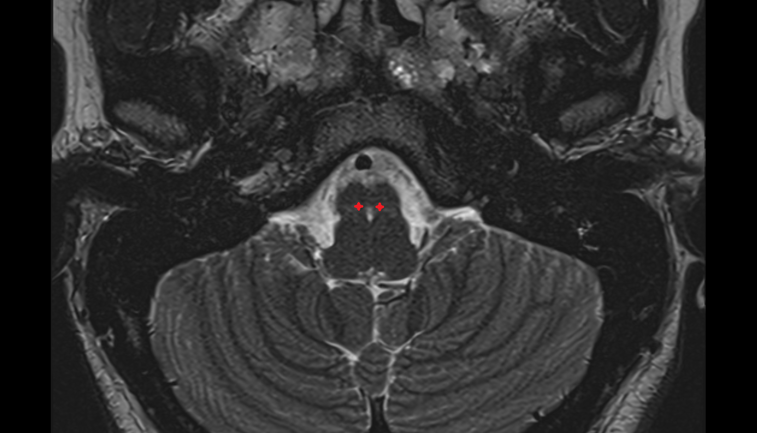 Inferior salivatory nucleus MRI 3T image