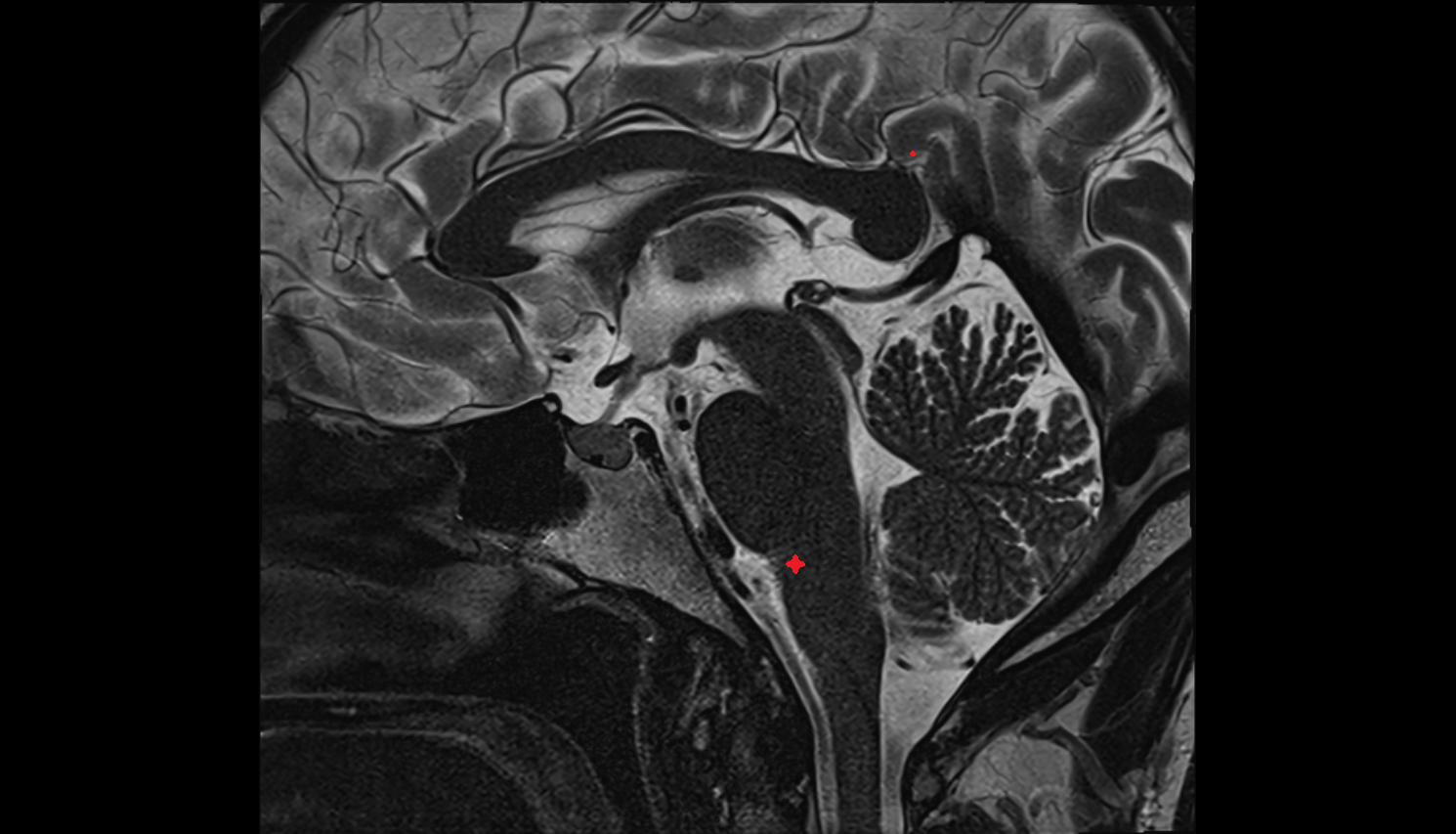 MRI Inferior salivatory nucleus  sag anatomy image -img-00000-00000