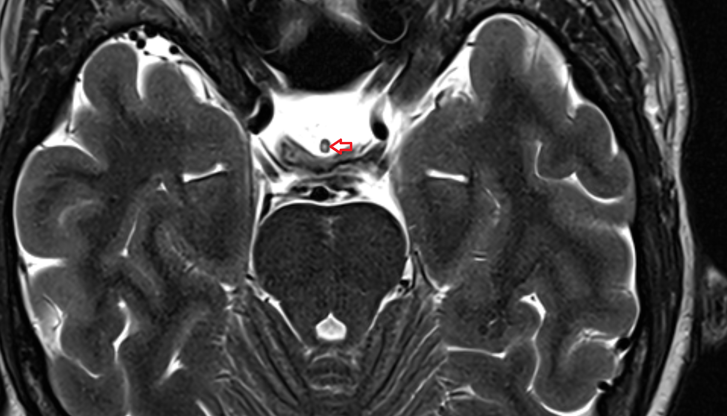 MRI Infundibulum axial anatomy image -img-00000-00000