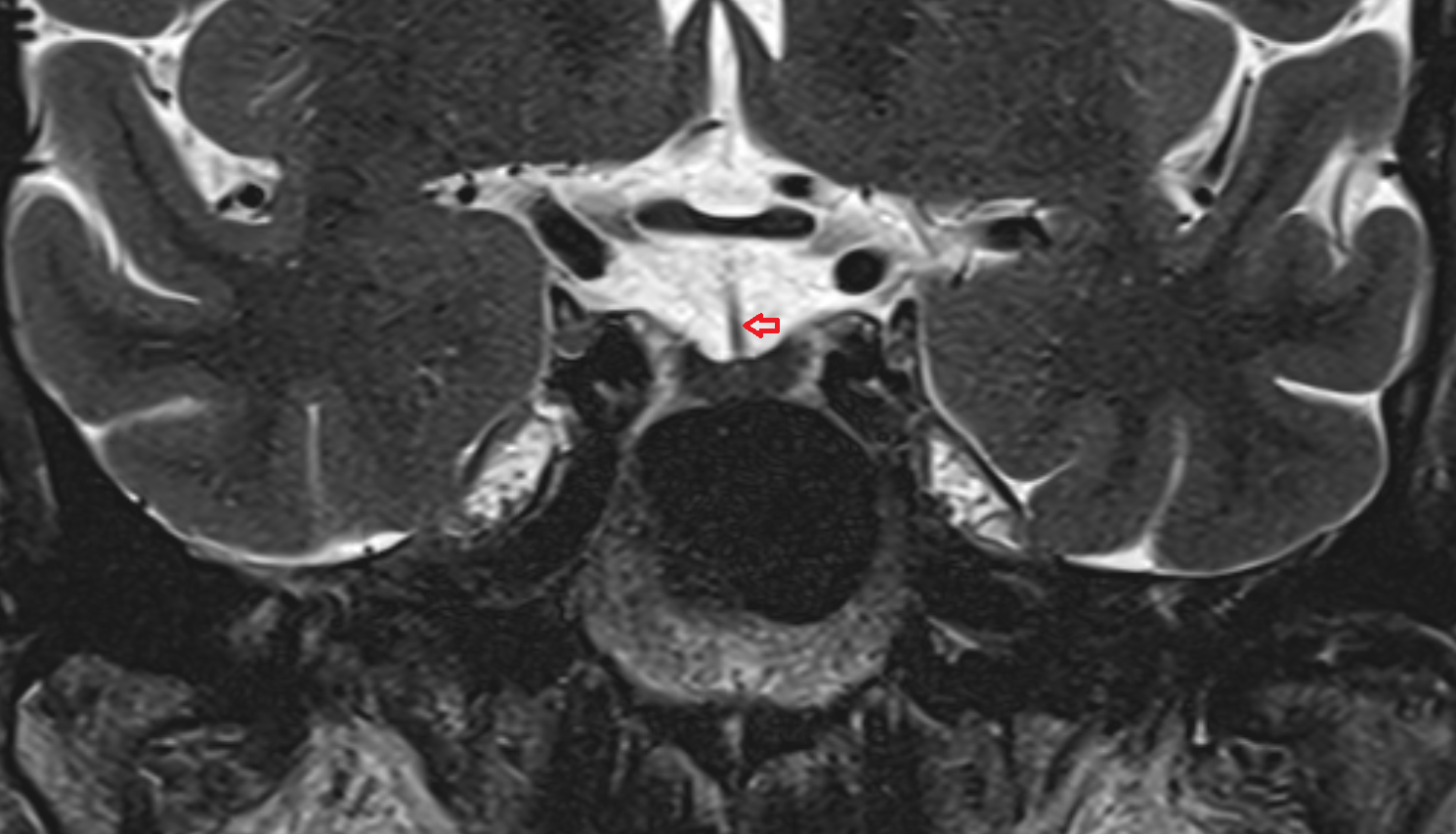 MRI Infundibulumcoronal anatomy image -img-00000-00000