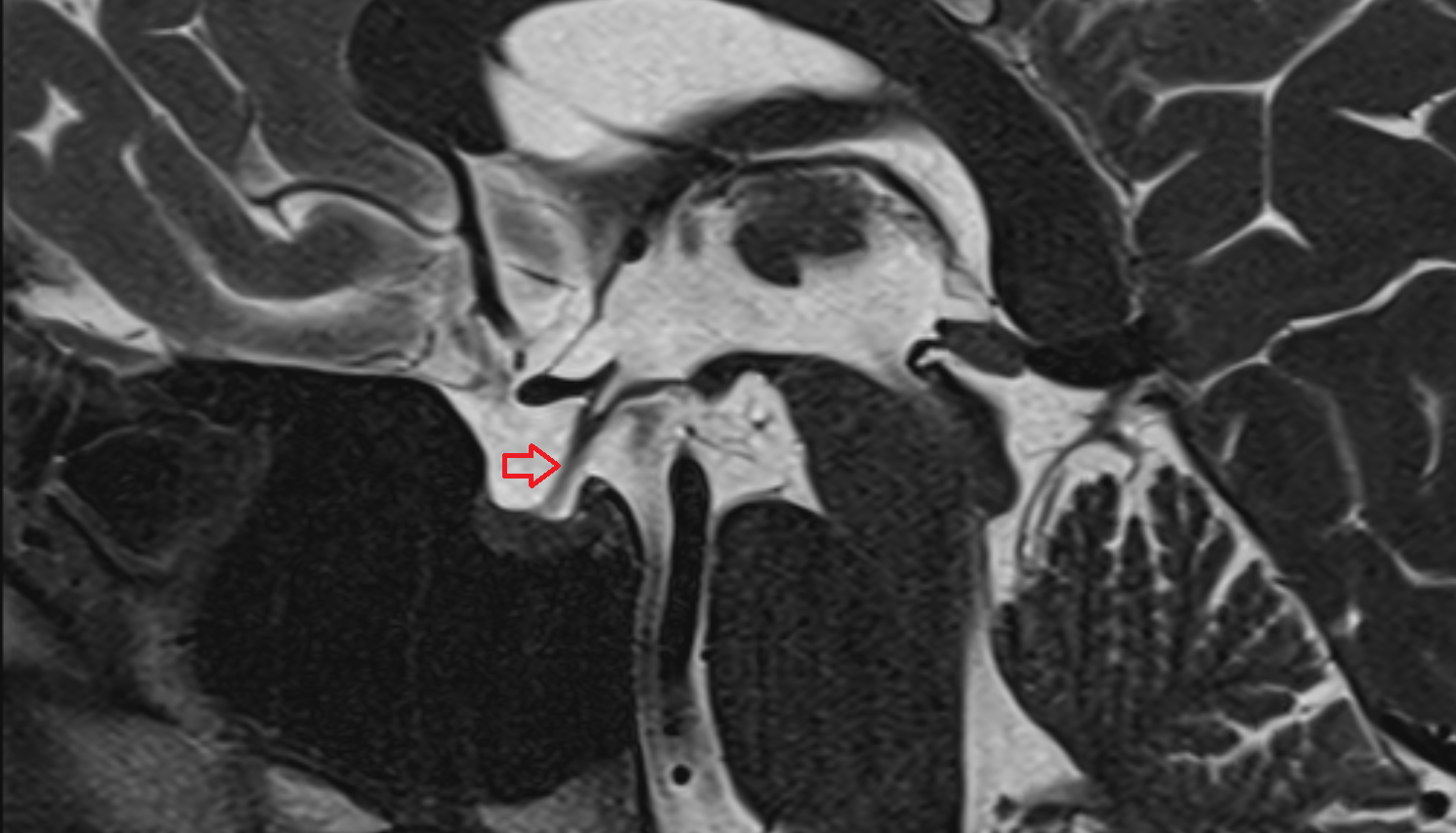 MRI Infundibulum sag anatomy image -img-00000-00000