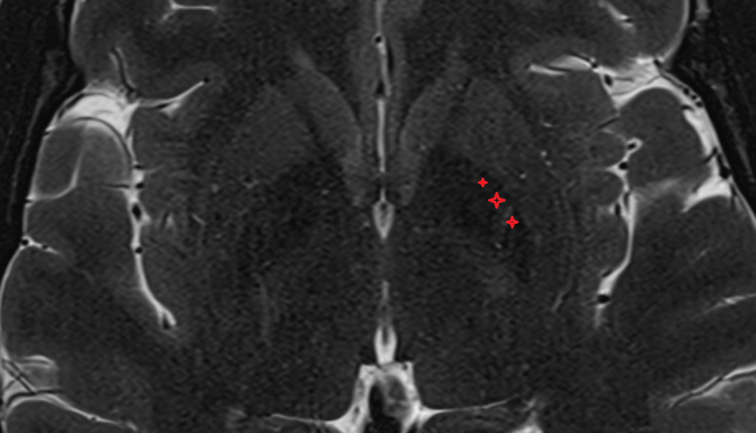 MRI Lateral (external) pallidum axial anatomy image -img-00000-00000