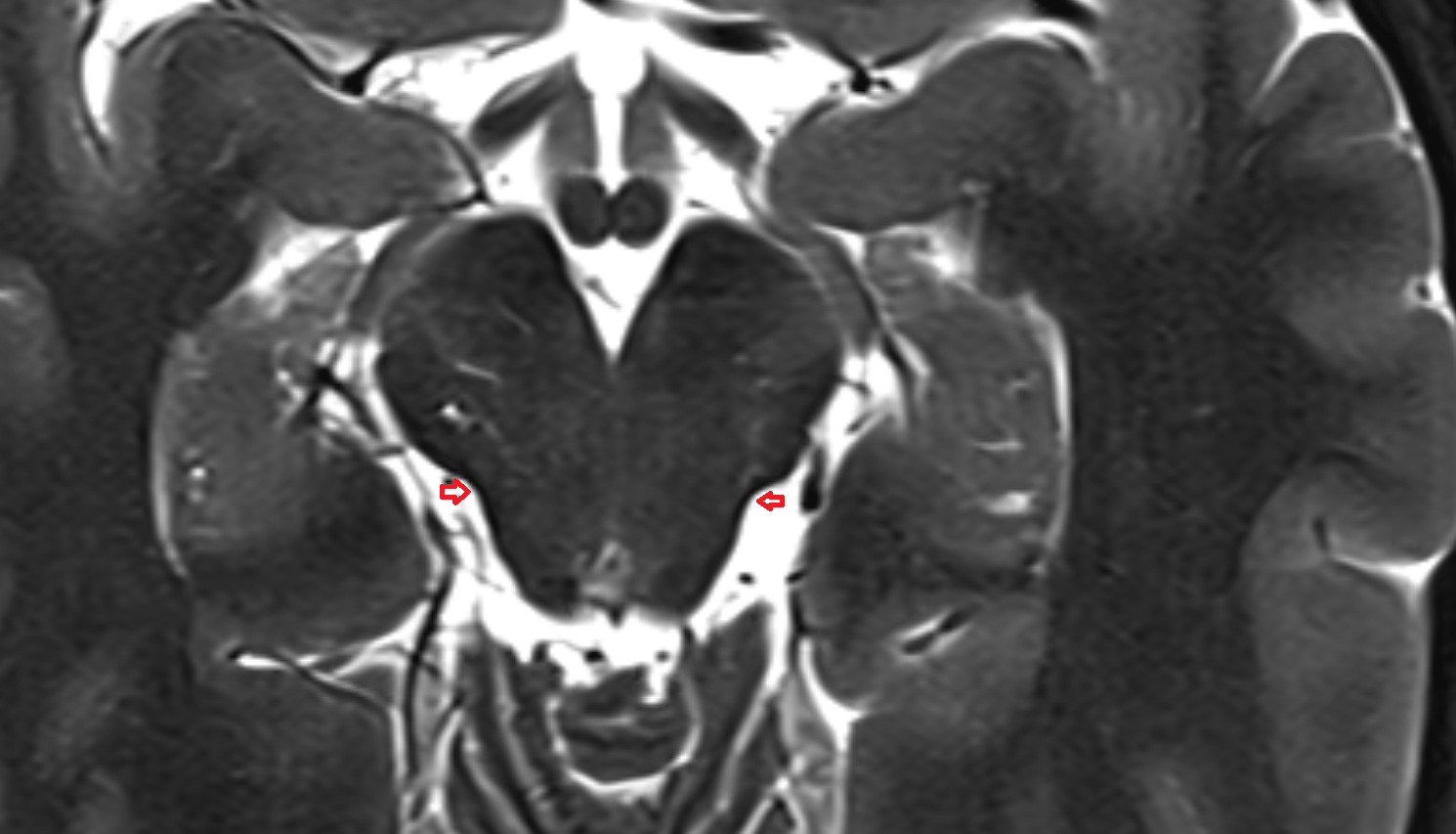 MRI Lateral groove of midbrain anatomy image -img-00000-00000_00001