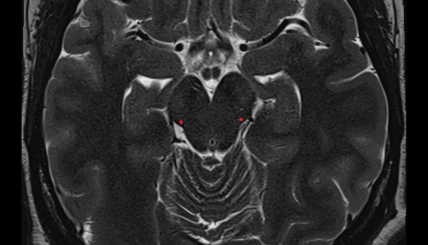 MRI Lateral lemniscus axial anatomy image -img-00000-00000