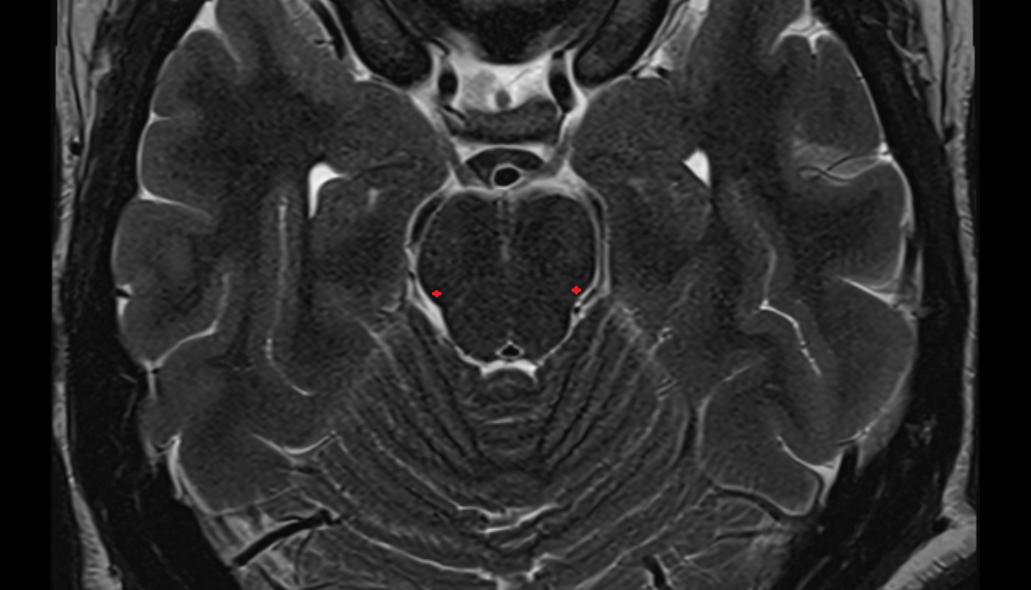 MRI Lateral lemniscus axial anatomy image -img-00000-00000_00001