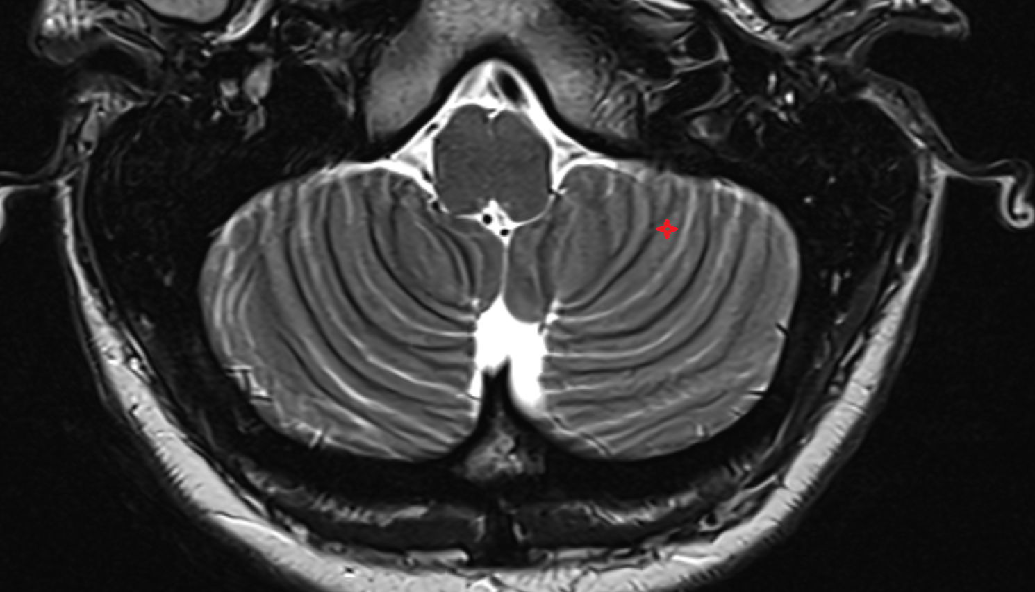 MRI Lateral part of biventeral lobule axial anatomy image -img-00000-00000