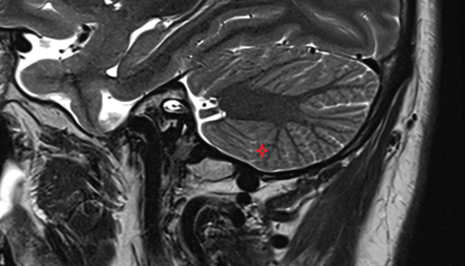 MRI  Lateral part of biventeral lobule sag anatomy image -img-00000-00000
